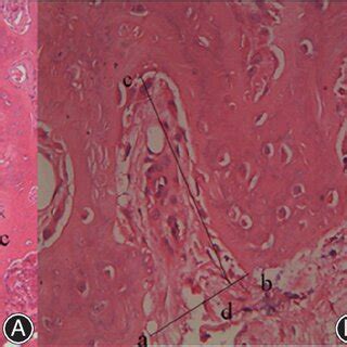 Giant Tumor Of Bone GCTB Located At Distal Femora A Arrow Refers