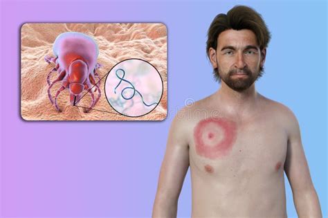 A Man With Erythema Migrans A Characteristic Rash Of Lyme Disease Caused By Borrelia