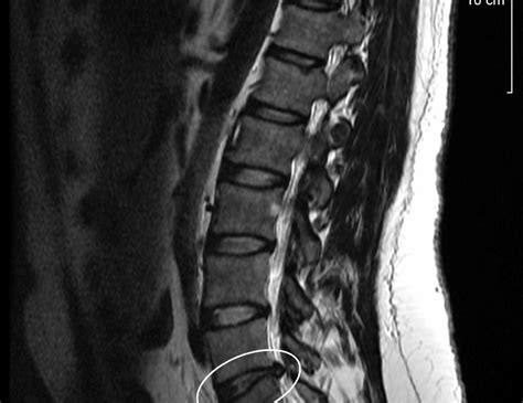 Resonancia Magn Tica En La Regi N Lumbar Diagn Stico Especializado