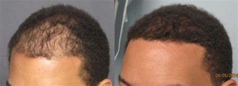 Fue Hair Transplant Los Angeles | Dr. Sean Behnam