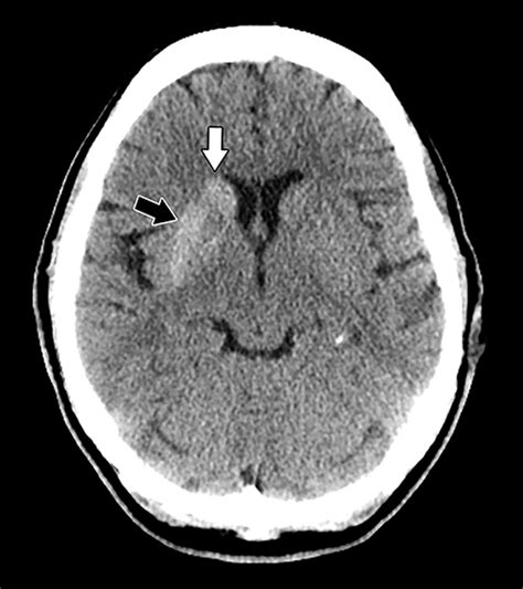 Nonketotic Hyperglycemia Induced Hemichorea Hemiballism Applied Radiology