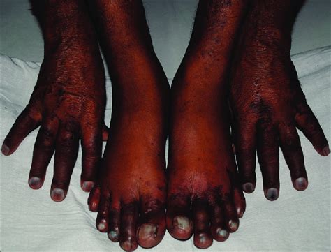 Clinical photograph showing acrocyanosis | Download Scientific Diagram