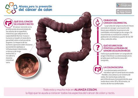 Prevenir Es Ganar En C Ncer Colorrectal Ccr Ya Que Se Podr A Reducir