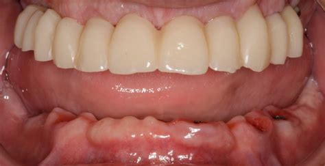 Cirug A Bucal Periodoncia E Implantolog A Caso Complejo Dental