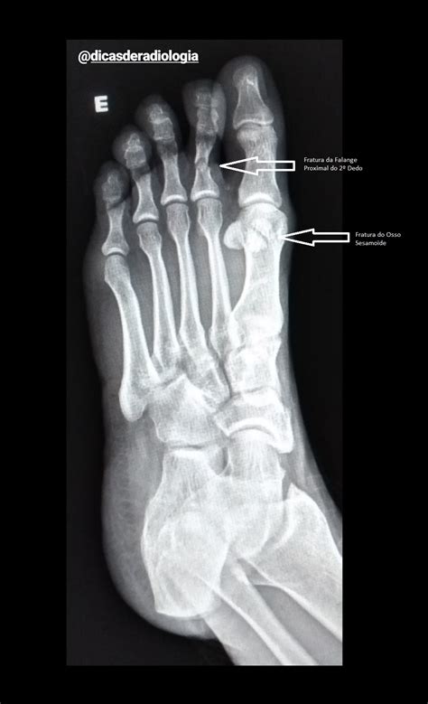 Dicas De Radiologia Tudo Sobre Radiologia Imagens RadiolÓgicas Fratura Osso Sesamoide E