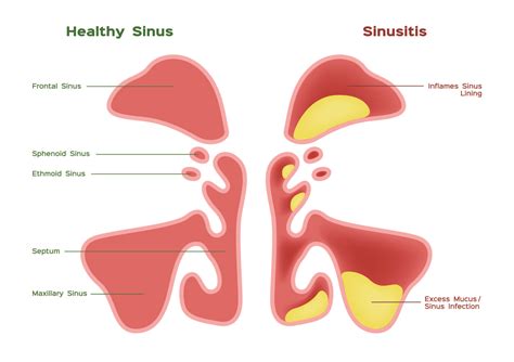 Chronic Sinusitis Diagnosis And Treatment Ent Las Vegas