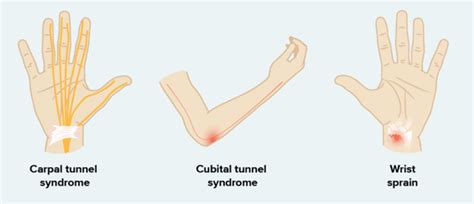 Wrist Pain and Causes - Circle 8 Massage