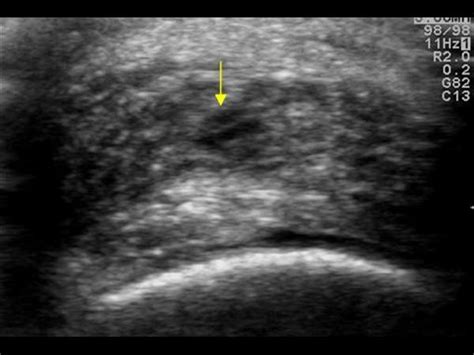 Musculoskeletal Joints and Tendons | 6.7 Ankle : Case 6.7.6 Achilles tendon bursitis ...