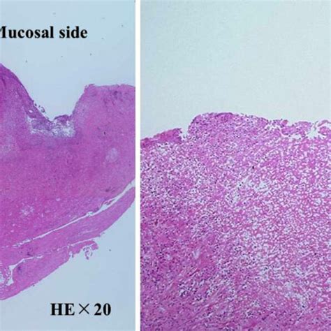 Histological Findings Of The Resected Specimen Show Deep Ulceration