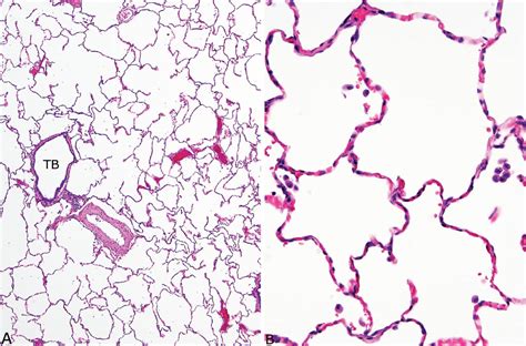 Normal Lung Common Artifacts And Incidental Findings Thoracic Key