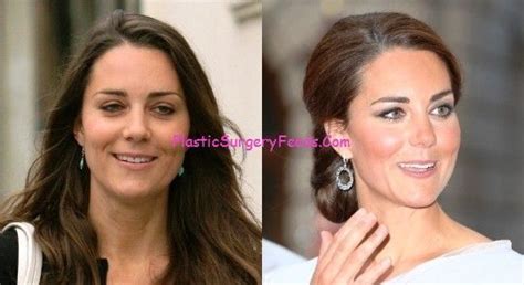 Kate Middleton Plastic Surgery Before And After Eyes Nose Job And Teeth Surgery Plastic