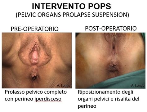 Prolasso Utero E Vescica La Tecnica Pops Che Salva Lutero