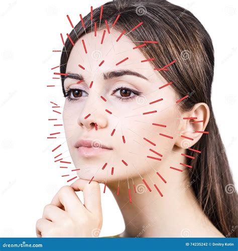 Close Up Of Performing Acupuncture Therapy On Face Stock Photo Image