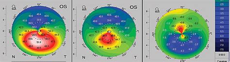 Update On Corneal Crosslinking And Topography Guided Prk In 41 Off