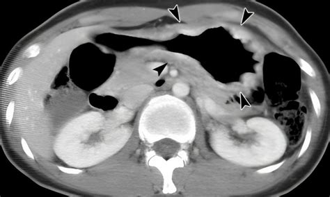 Is Stomach Cancer Curable Diagnosis Staging And Treatment