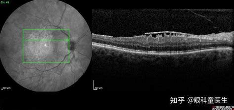 黄斑疾病——4、黄斑前膜 知乎