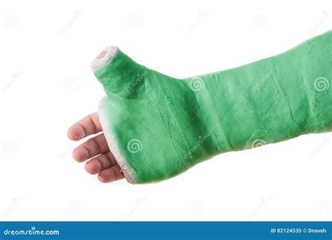 Arm Plaster Fiberglass Cast With The Thumb Extended Stock Image