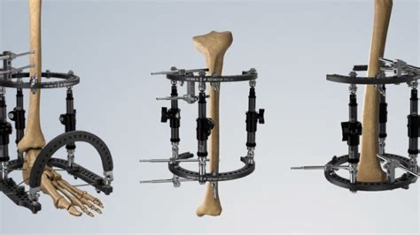 Truelok Evo Ring Fixation System Orthofix