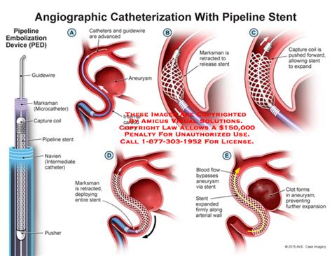 Amicus Illustration Of Amicussurgeryangiographiccatheterization