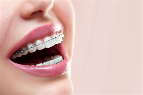 Diferencia entre brackets metálicos estéticos o linguales