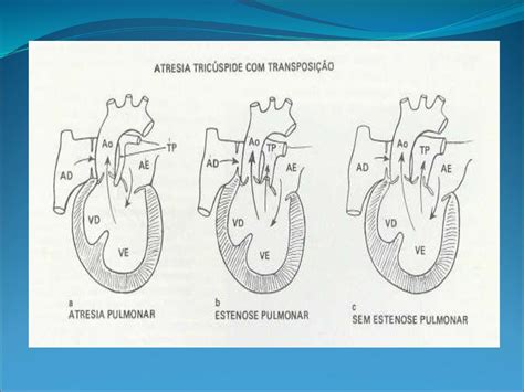 Caso Clinico Atresia Tric Spide Ppt Carregar