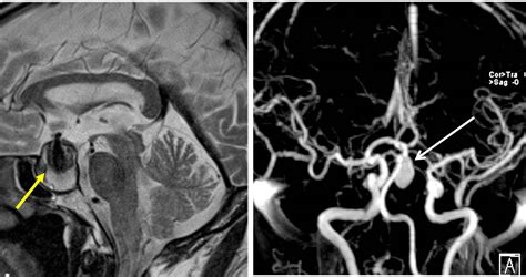 Intrasellar Aneurysm Radiology Cases