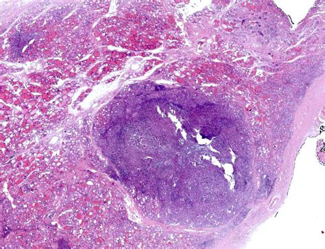 Pathology Outlines Langerhans Cell Histiocytosis