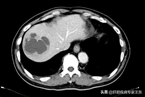 查體發現肝臟陰影，除了肝癌之外，還可能是哪些病？ 每日頭條