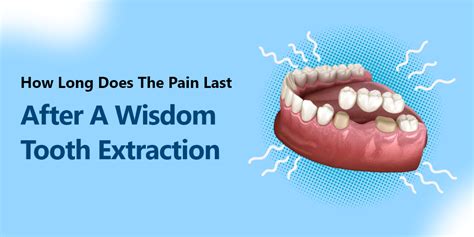 How Long Does The Pain Last After A Wisdom Tooth Extraction LA