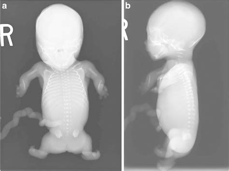 Postmortem Radiographs Anteroposterior A And Lateral B Images