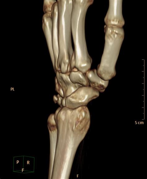 Radiopaedia case Triquetral fracture id: 52227 study: 58109 - NC Commons