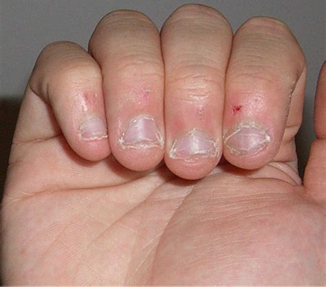 Nail Diseases And Disorders Flashcards Quizlet