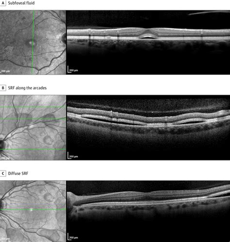 Subretinal Fluid Associated With Mek Inhibitor Use In The Treatment Of Systemic Cancer