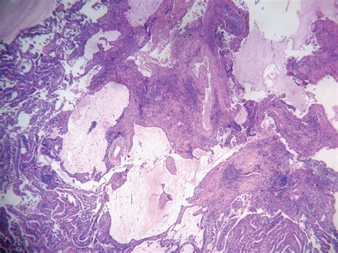 Primary Pulmonary Colloid Adenocarcinoma A Case Report With Literature Review