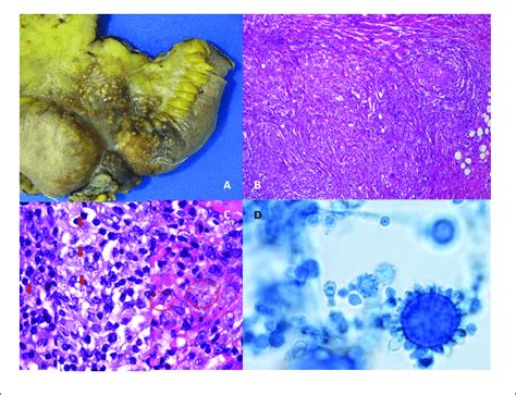 | Morphological appearance of Histoplasma capsulatum var. capsulatum in ...