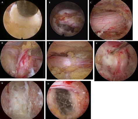 Rationale And Advantages Of Endoscopic Spine Surgery International