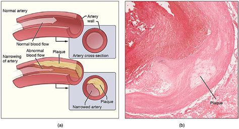 Atherosclerosis How Does It Happen By Jeffrey Dach Md Jeffrey Dach Md