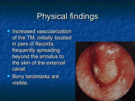 Acute Otitis Media And Mastoiditis