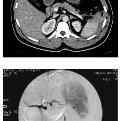 Ct Scan Showing Contrast Blush In Grade Ii Splenic Injury Which Was