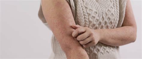 Traitements Naturels Pour Soulager Les Sympt Mes Du Psoriasis