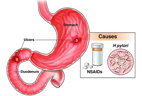 Ulcers - SATVIC