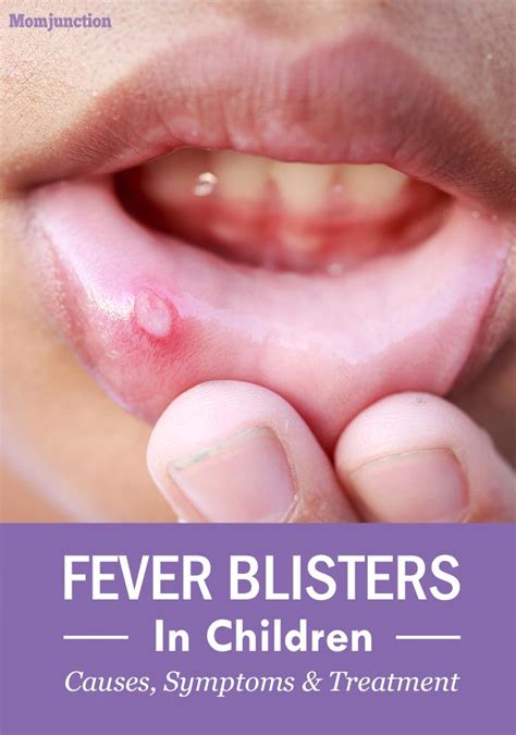 Cold Sores (Fever Blisters) In Kids: Causes And Treatment