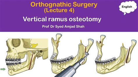 Vertical Ramus Osteotomy Orthognathic Surgery Oral Maxillofacial