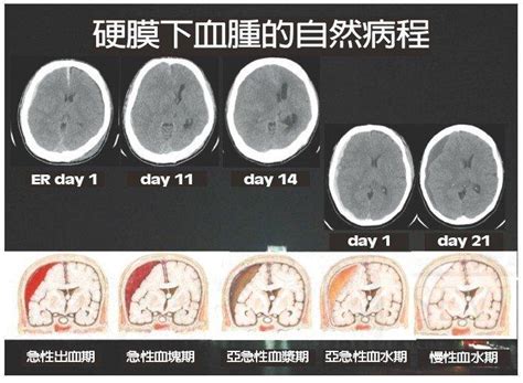 康复医学基本功：颅脑损伤5大类型，你知道吗？ 知乎