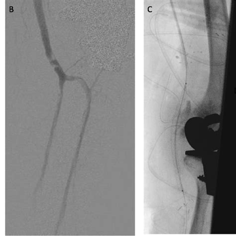 Peripheral Artery Images Pre And Post Endovascular Therapy EVT And