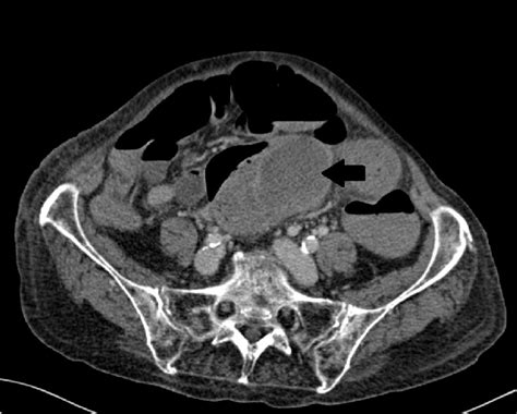 Axial Contrast Enhanced Computed Tomography Depicting An Intramural