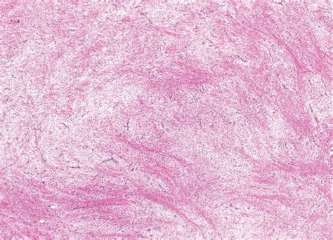 Myxoid Cutaneous Tumors A Review Zou Journal Of Cutaneous