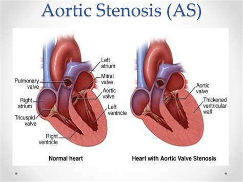 Ppt Congenital Heart Disease Powerpoint Presentation Free Download