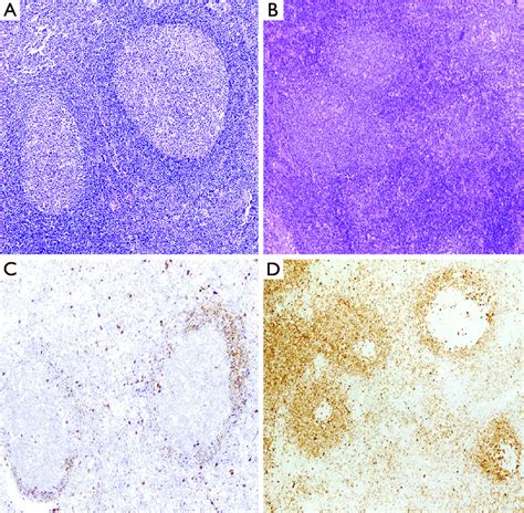 In Situ Mantle Cell Neoplasia And Mantle Cell Lymphoma With A Mantle Download Scientific