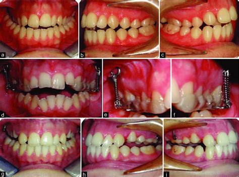 A C Pretreatment Intraoral Photos Presenting Maxillary Constriction